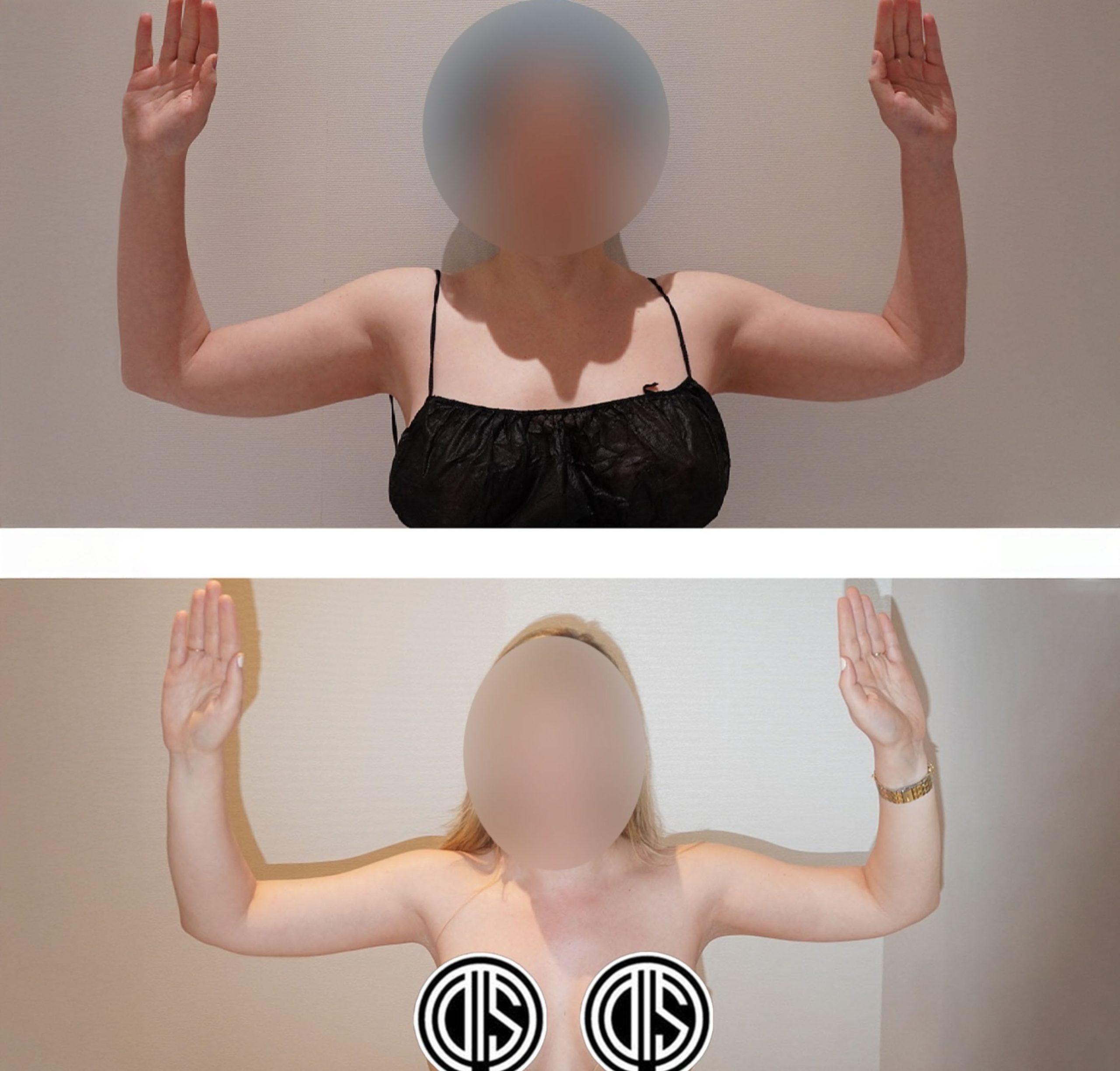 Two side-by-side photos of a woman with arms raised, showing her upper body before and after arm liposuction; her face and chest are blurred for privacy, highlighting picture-perfect arms.